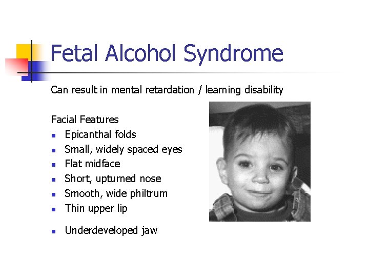 Fetal Alcohol Syndrome Can result in mental retardation / learning disability Facial Features n
