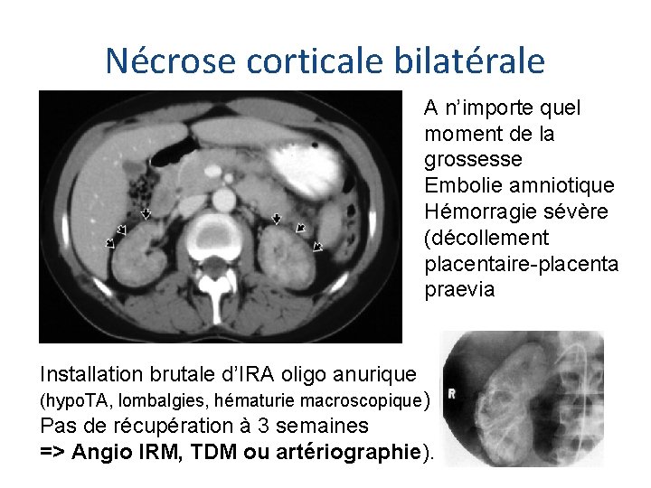 Nécrose corticale bilatérale A n’importe quel moment de la grossesse Embolie amniotique Hémorragie sévère