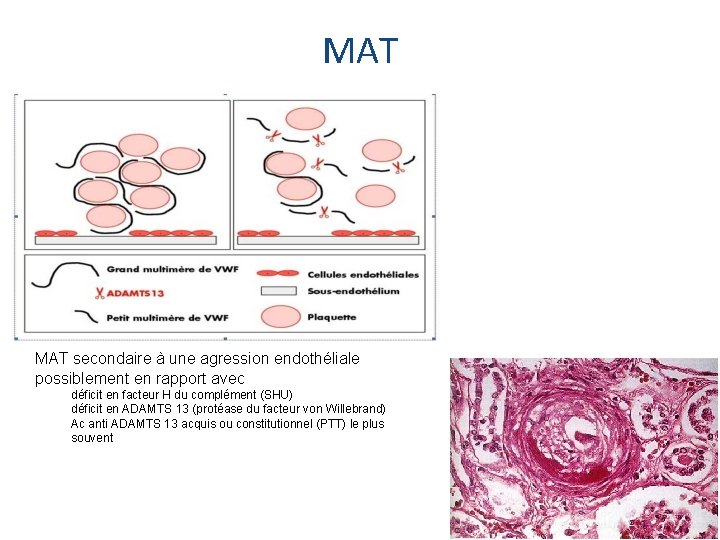 MAT secondaire à une agression endothéliale possiblement en rapport avec déficit en facteur H
