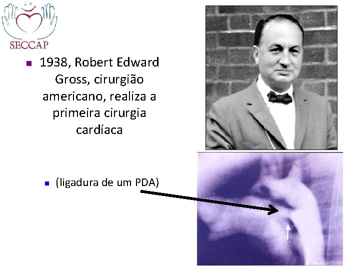 n 1938, Robert Edward Gross, cirurgião americano, realiza a primeira cirurgia cardíaca n (ligadura