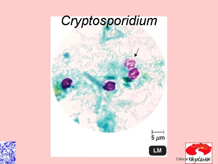 Cryptosporidium Clinical Focus, p. 355 Cryptosporidium Clinical Focus, p. 355
