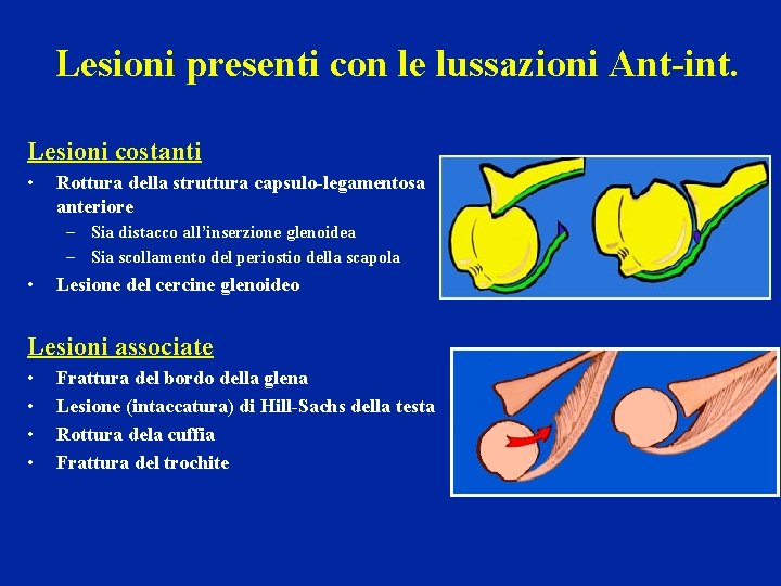 Lesioni presenti con le lussazioni Ant-int. Lesioni costanti • Rottura della struttura capsulo-legamentosa anteriore