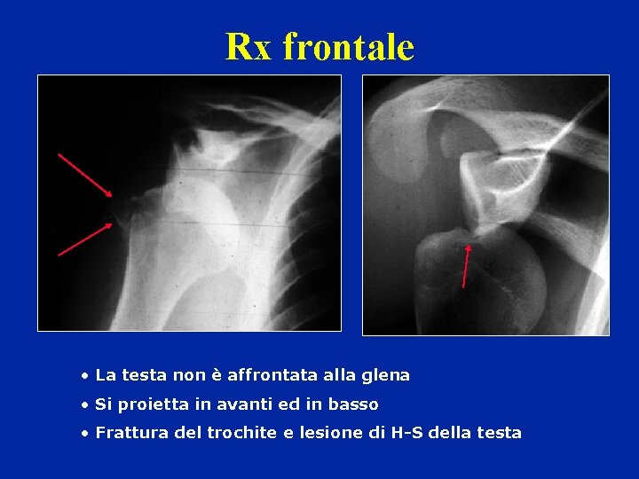 Rx frontale • La testa non è affrontata alla glena • Si proietta in