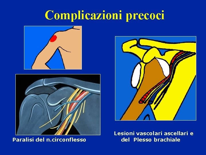 Complicazioni precoci Paralisi del n. circonflesso Lesioni vascolari ascellari e del Plesso brachiale 