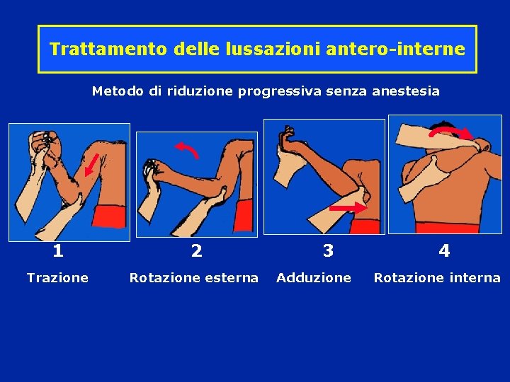 Trattamento delle lussazioni antero-interne Metodo di riduzione progressiva senza anestesia 1 Trazione 2 3