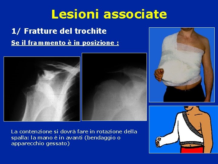 Lesioni associate 1/ Fratture del trochite Se il frammento è in posizione : La