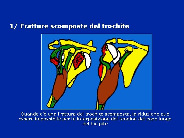 1/ Fratture scomposte del trochite Quando c’è una frattura del trochite scomposta, la riduzione