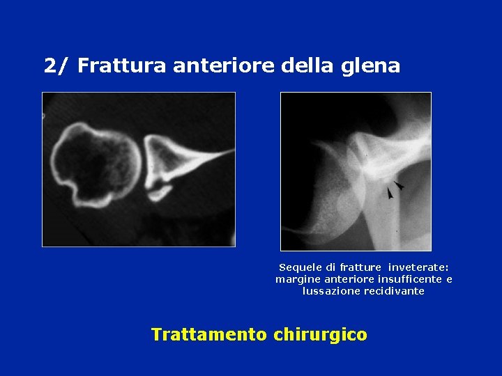 2/ Frattura anteriore della glena Sequele di fratture inveterate: margine anteriore insufficente e lussazione