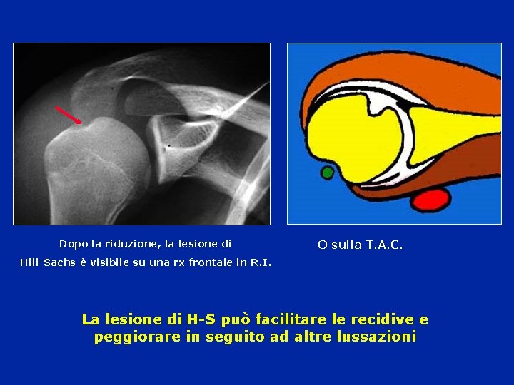 Dopo la riduzione, la lesione di O sulla T. A. C. Hill-Sachs è visibile