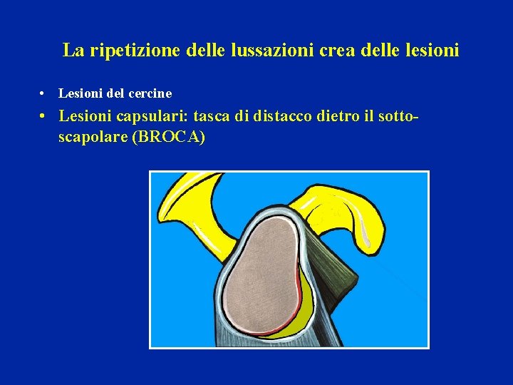 La ripetizione delle lussazioni crea delle lesioni • Lesioni del cercine • Lesioni capsulari: