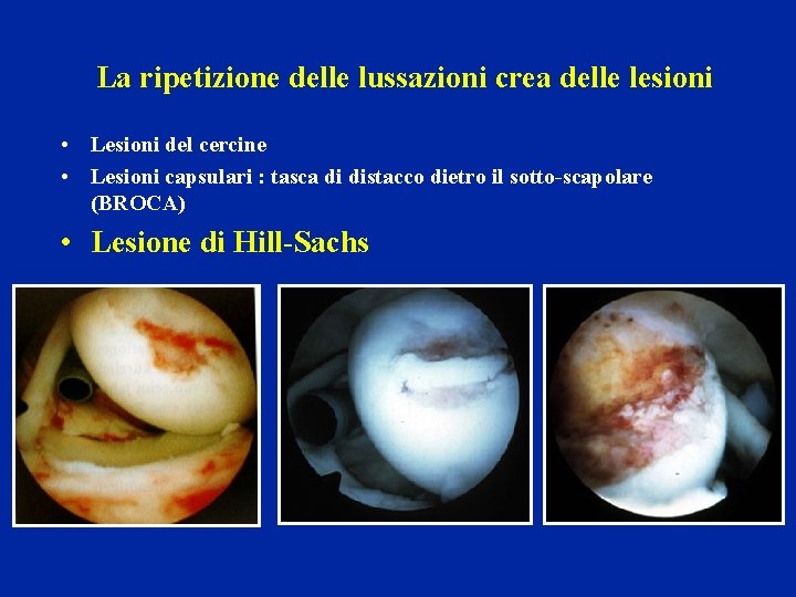 La ripetizione delle lussazioni crea delle lesioni • Lesioni del cercine • Lesioni capsulari