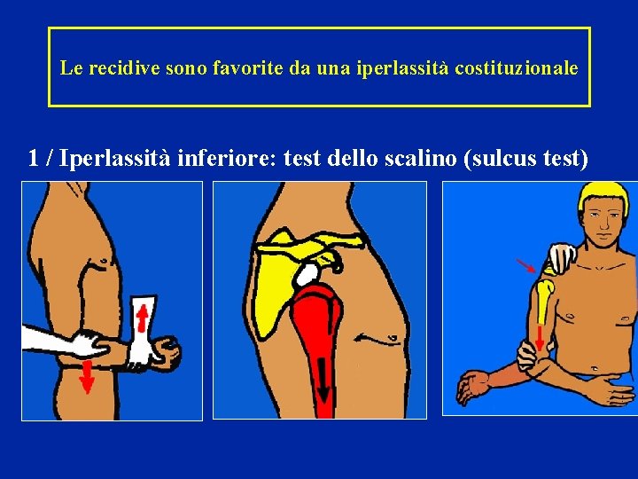 Le recidive sono favorite da una iperlassità costituzionale 1 / Iperlassità inferiore: test dello