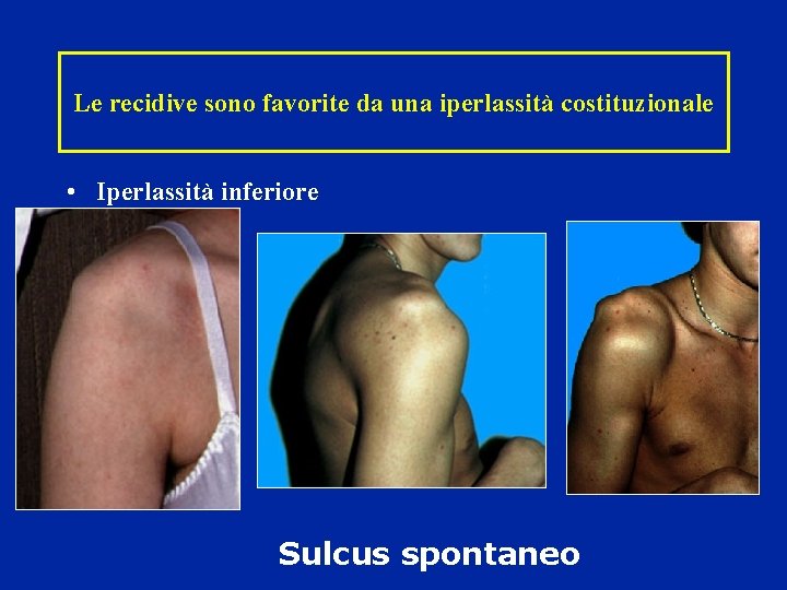 Le recidive sono favorite da una iperlassità costituzionale • Iperlassità inferiore Sulcus spontaneo 