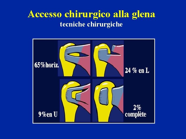 Accesso chirurgico alla glena tecniche chirurgiche 