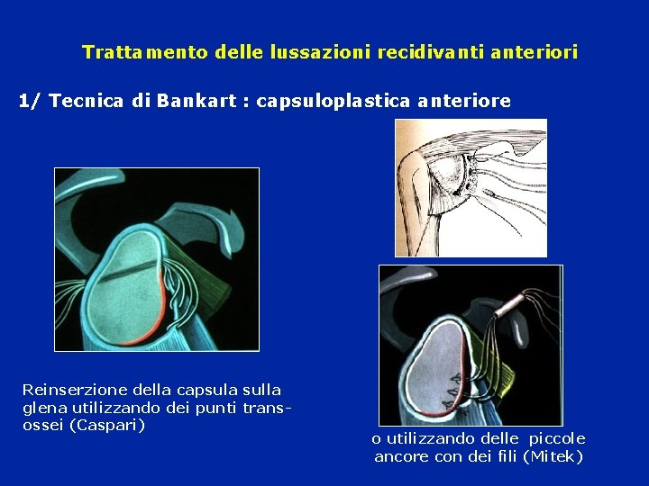 Trattamento delle lussazioni recidivanti anteriori 1/ Tecnica di Bankart : capsuloplastica anteriore Reinserzione della