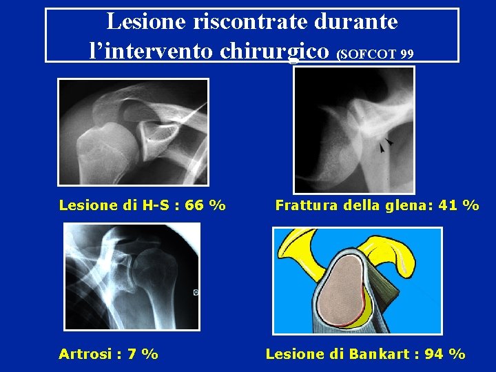 Lesione riscontrate durante l’intervento chirurgico (SOFCOT 99 Lesione di H-S : 66 % Frattura