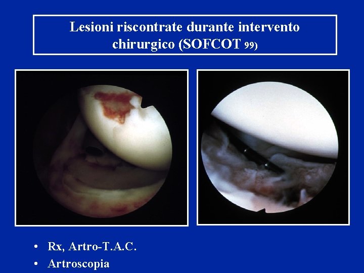 Lesioni riscontrate durante intervento chirurgico (SOFCOT 99) • Rx, Artro-T. A. C. • Artroscopia