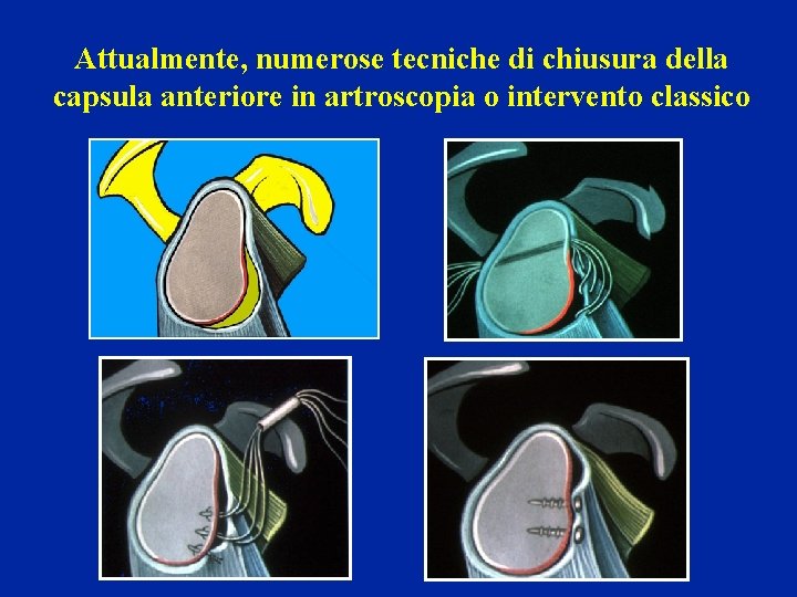 Attualmente, numerose tecniche di chiusura della capsula anteriore in artroscopia o intervento classico 