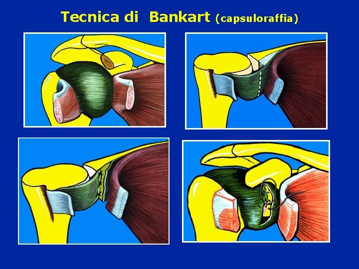 Tecnica di Bankart (capsuloraffia) 