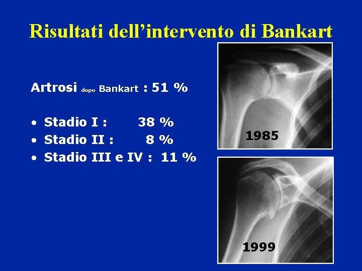 Risultati dell’intervento di Bankart Artrosi dopo Bankart : 51 % • Stadio I :