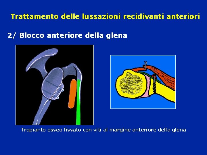 Trattamento delle lussazioni recidivanti anteriori 2/ Blocco anteriore della glena Trapianto osseo fissato con