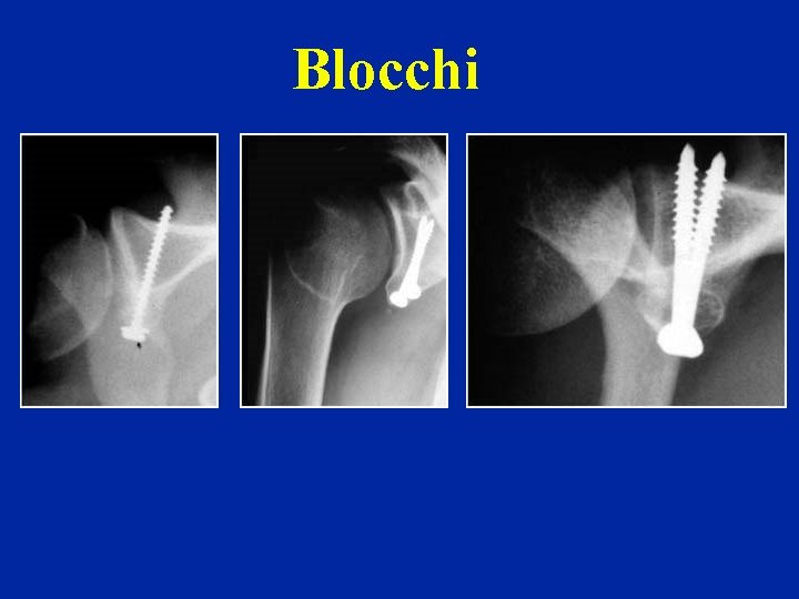 Blocchi 