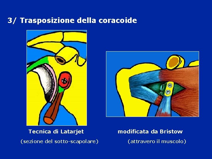 3/ Trasposizione della coracoide Tecnica di Latarjet modificata da Bristow (sezione del sotto-scapolare) (attravero