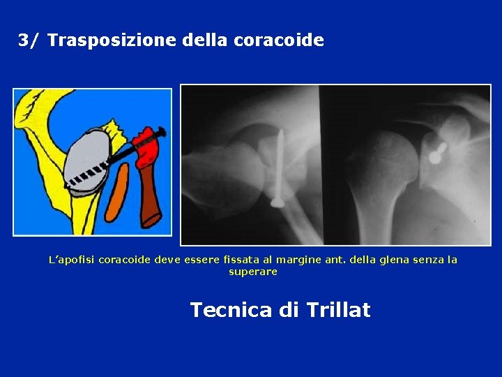 3/ Trasposizione della coracoide L’apofisi coracoide deve essere fissata al margine ant. della glena