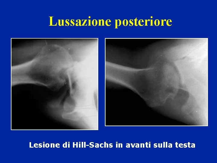 Lussazione posteriore Lesione di Hill-Sachs in avanti sulla testa 