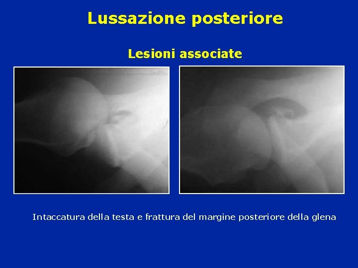 Lussazione posteriore Lesioni associate Intaccatura della testa e frattura del margine posteriore della glena