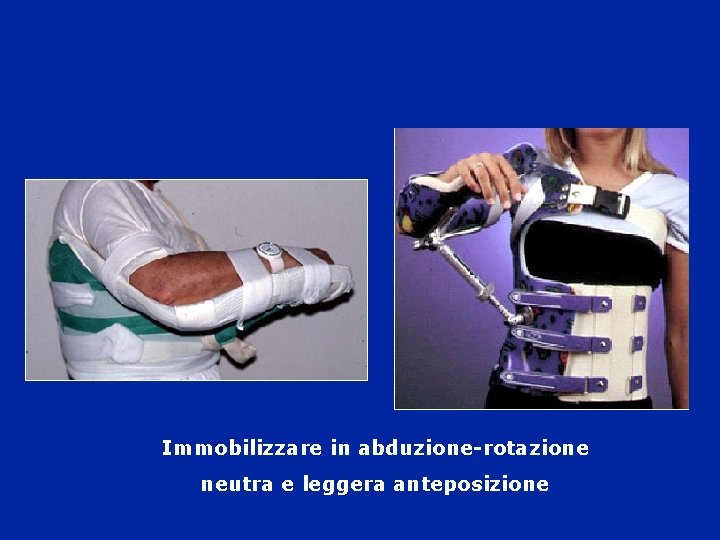 Immobilizzare in abduzione-rotazione neutra e leggera anteposizione 