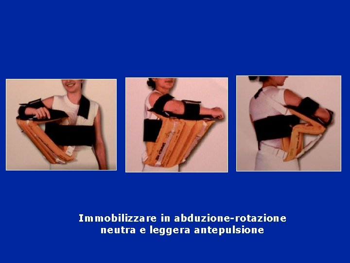 Immobilizzare in abduzione-rotazione neutra e leggera antepulsione 