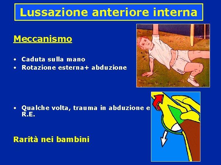 Lussazione anteriore interna Meccanismo • Caduta sulla mano • Rotazione esterna+ abduzione • Qualche