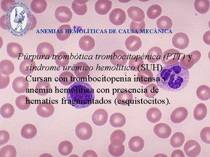 ANEMIAS HEMOLÍTICAS DE CAUSA MECÁNICA Púrpura trombótica trombocitopénica (PTT) y síndrome urémico hemolítico (SUH).