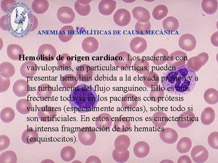 ANEMIAS HEMOLÍTICAS DE CAUSA MECÁNICA Hemólisis de origen cardíaco. Los pacientes con valvulopatías, en