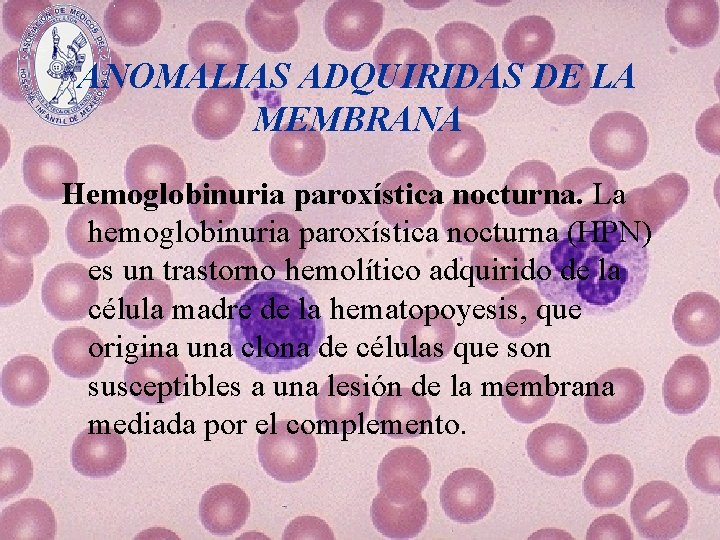 ANOMALIAS ADQUIRIDAS DE LA MEMBRANA Hemoglobinuria paroxística nocturna. La hemoglobinuria paroxística nocturna (HPN) es