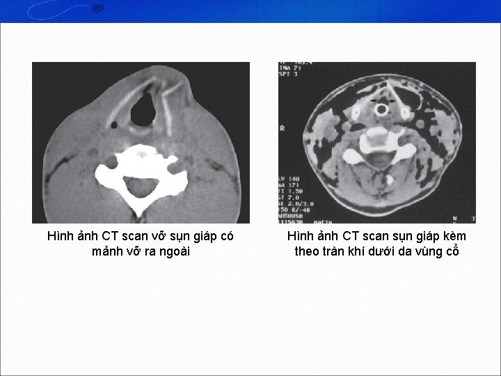 Hình ảnh CT scan vỡ sụn giáp có mảnh vỡ ra ngoài Hình ảnh