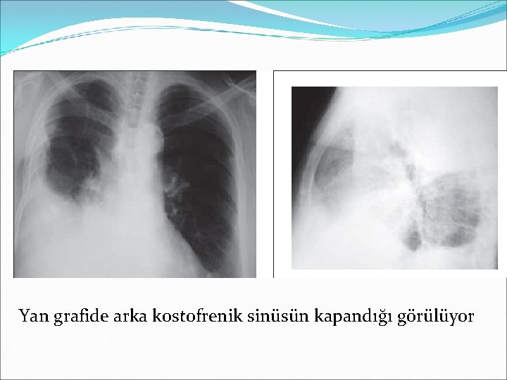 Yan grafide arka kostofrenik sinüsün kapandığı görülüyor 