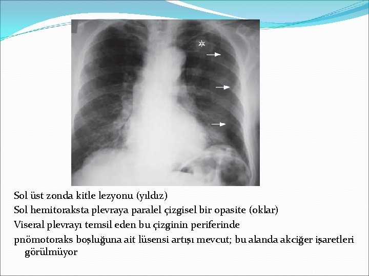 Sol üst zonda kitle lezyonu (yıldız) Sol hemitoraksta plevraya paralel çizgisel bir opasite (oklar)