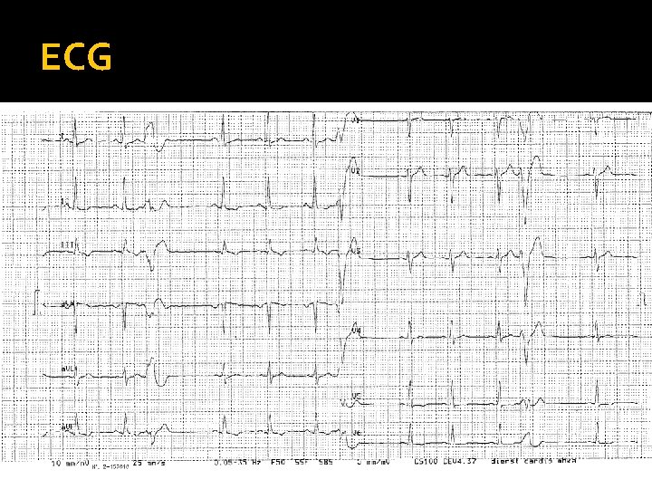 ECG 