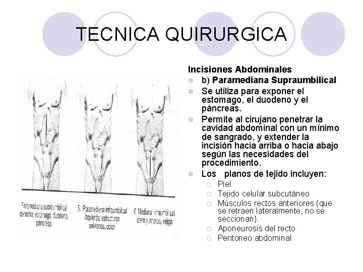 TECNICA QUIRURGICA Incisiones Abdominales l b) Paramediana Supraumbilical l Se utiliza para exponer el