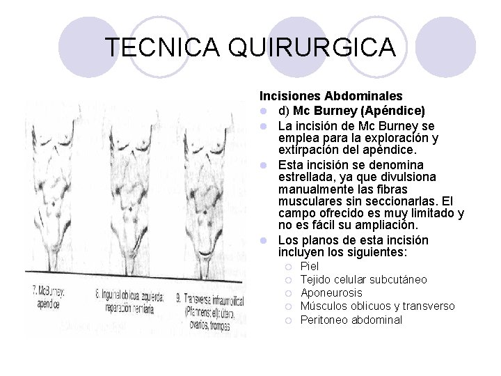 TECNICA QUIRURGICA Incisiones Abdominales l d) Mc Burney (Apéndice) l La incisión de Mc