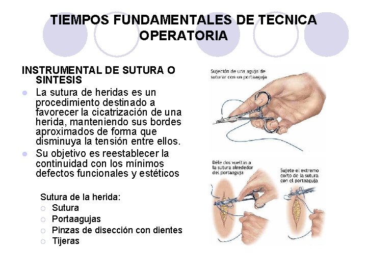 TIEMPOS FUNDAMENTALES DE TECNICA OPERATORIA INSTRUMENTAL DE SUTURA O SINTESIS l La sutura de