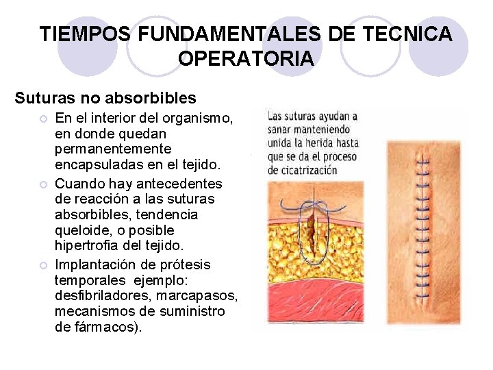 TIEMPOS FUNDAMENTALES DE TECNICA OPERATORIA Suturas no absorbibles ¡ ¡ ¡ En el interior