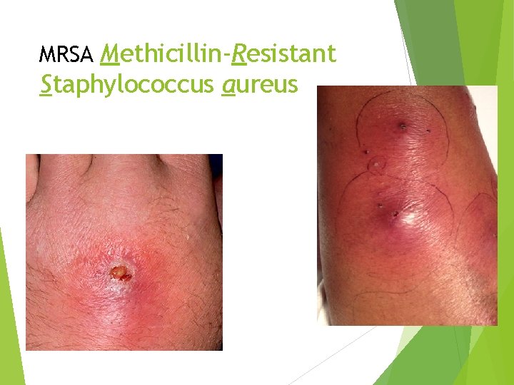 MRSA Methicillin-Resistant Staphylococcus aureus 