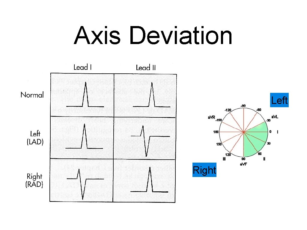 Axis Deviation Left Right 