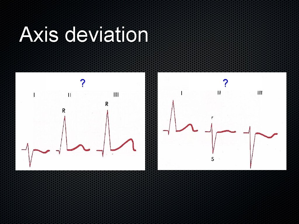 Axis deviation ? ? 
