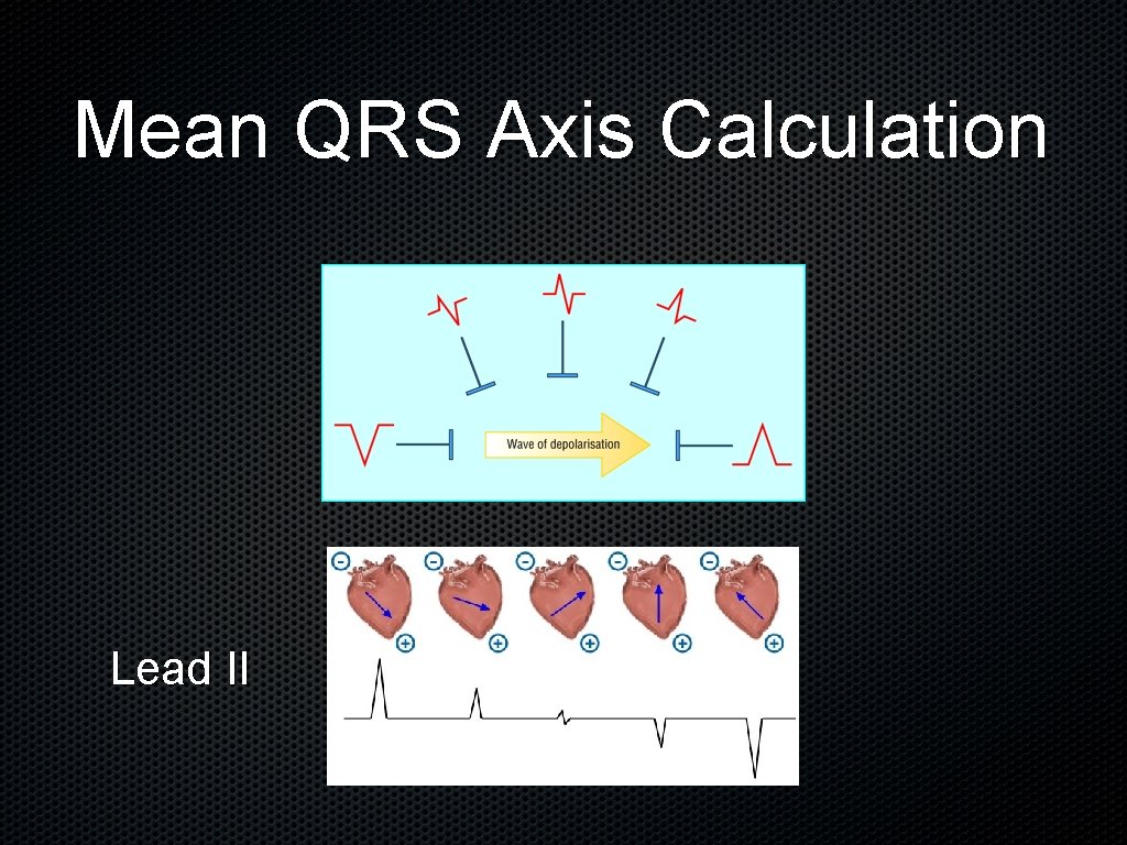 Mean QRS Axis Calculation Lead II 