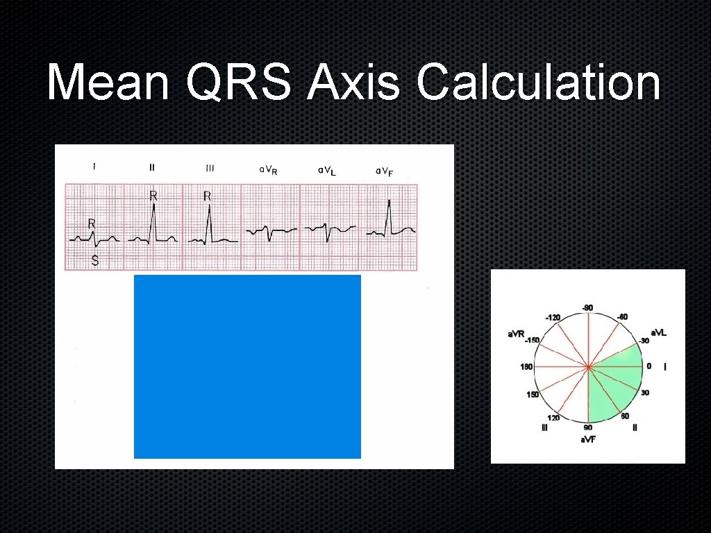 Mean QRS Axis Calculation 