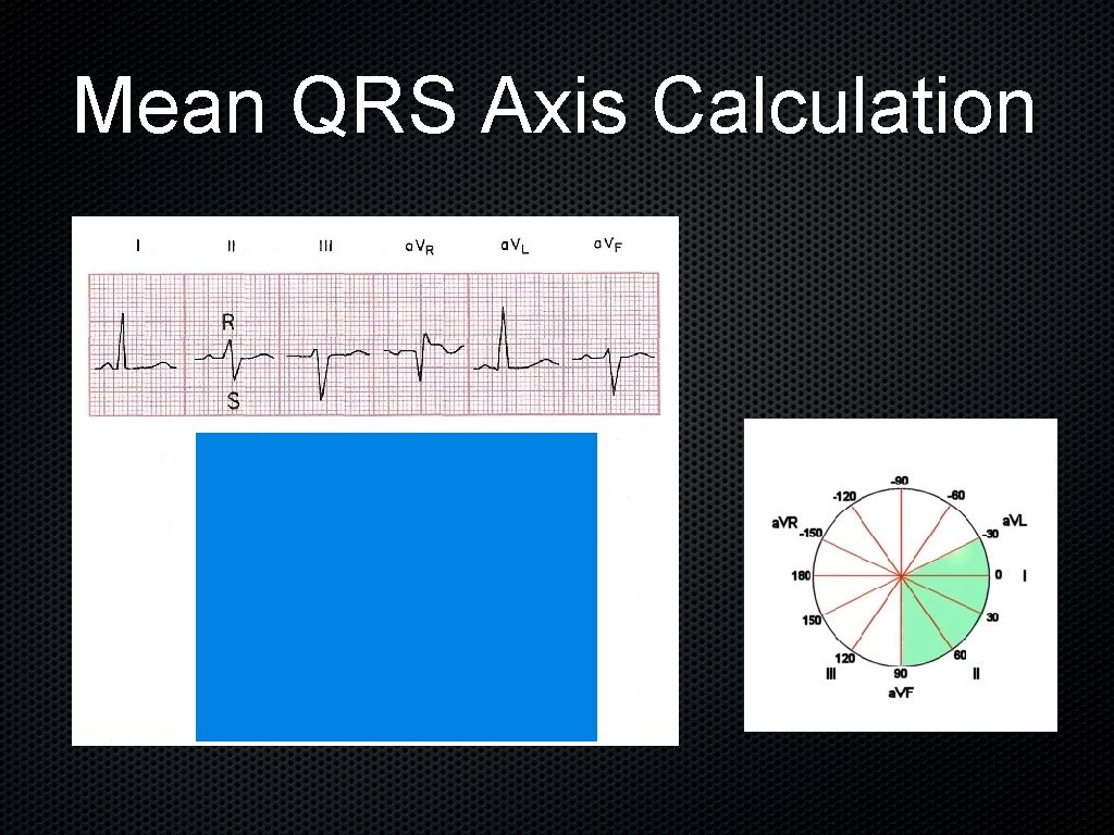 Mean QRS Axis Calculation 